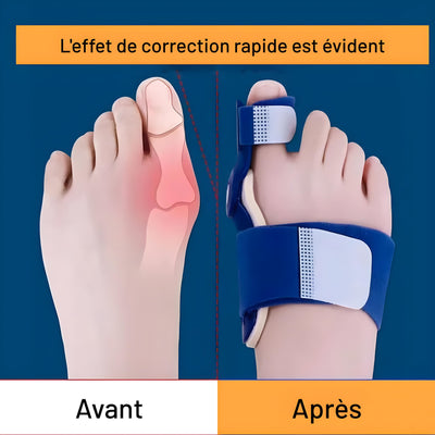 Correcteur Hallux Valgus Articulé – Redressement Progressif & Soulagement Durable